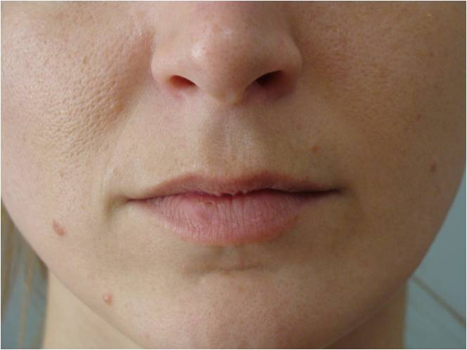 Restylane 1 mL